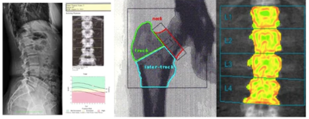 Who is at HIGH risk for low-trauma Fractures?