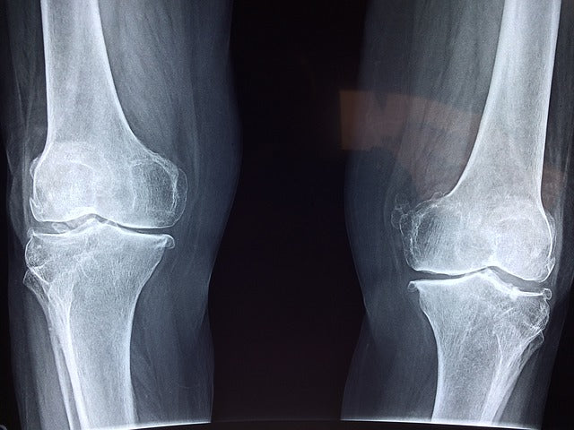 Fosamax for Your Bones: A Cautionary Tale