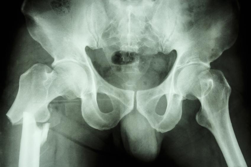 Topic: Surprising Facts About Bone Density Testing - Continuing Education