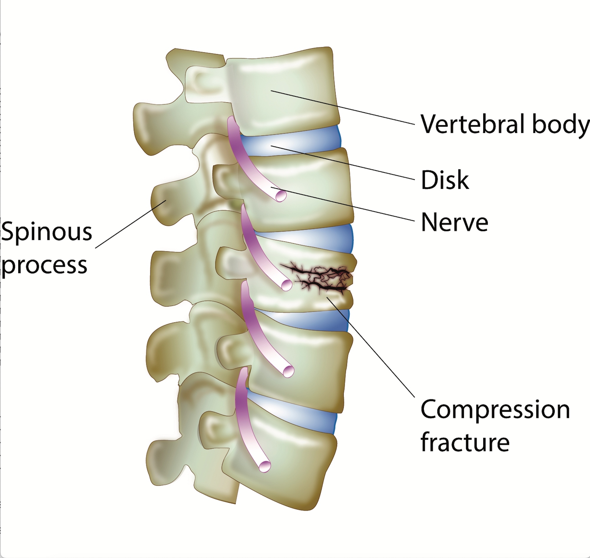 spinous process fracture