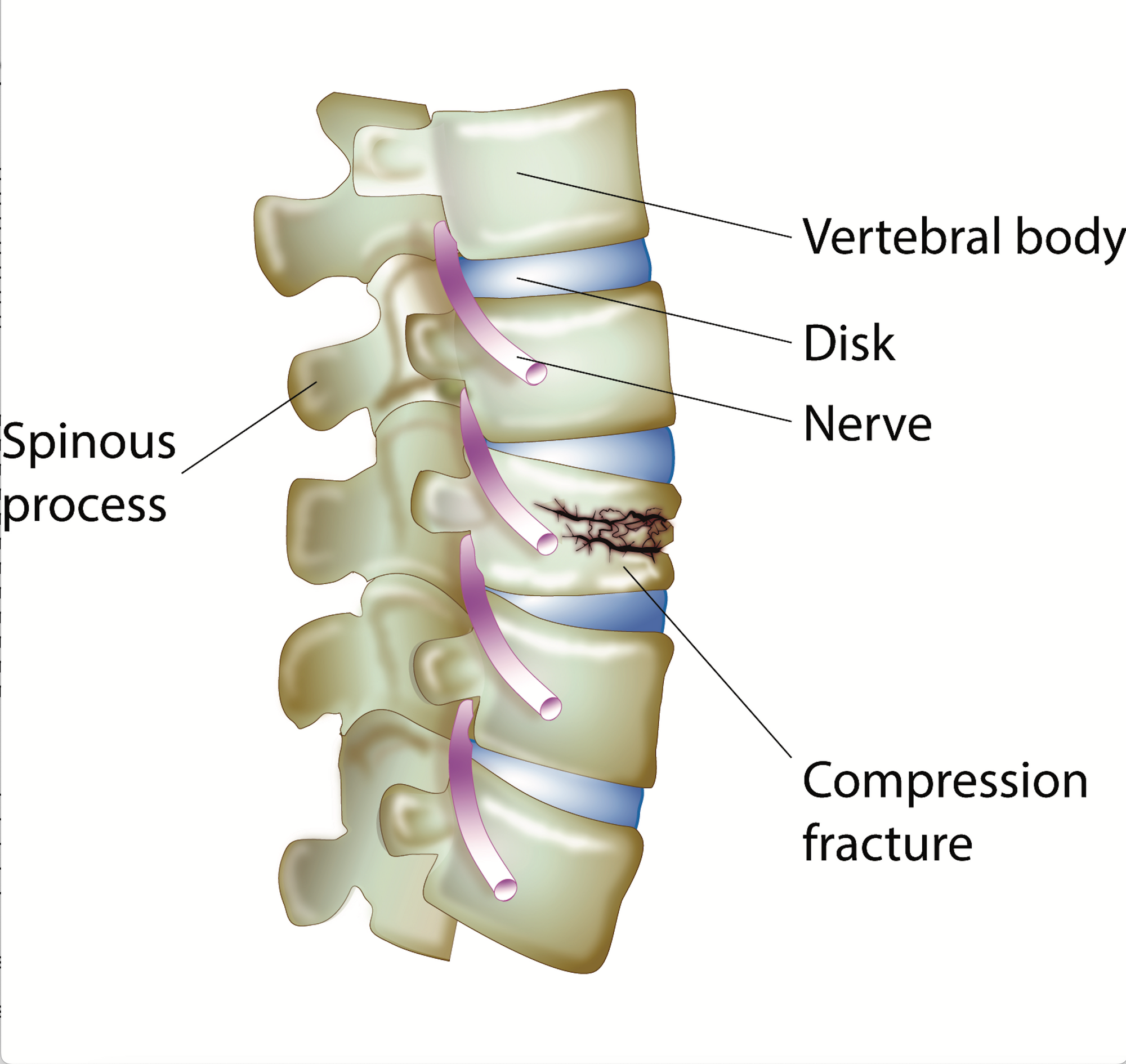 Physical Therapy in our clinic for Spinal Compression Fractures