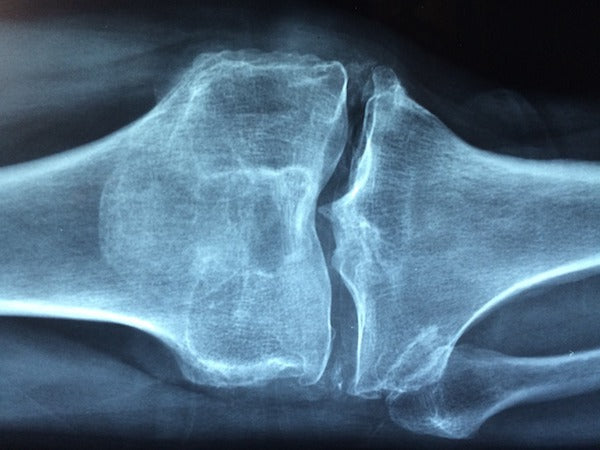 Osteoporosis - Information You Need to Know